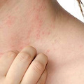 A Cava la "Giornata mondiale della psoriasi": 29 ottobre volontari in piazza e check up gratuiti